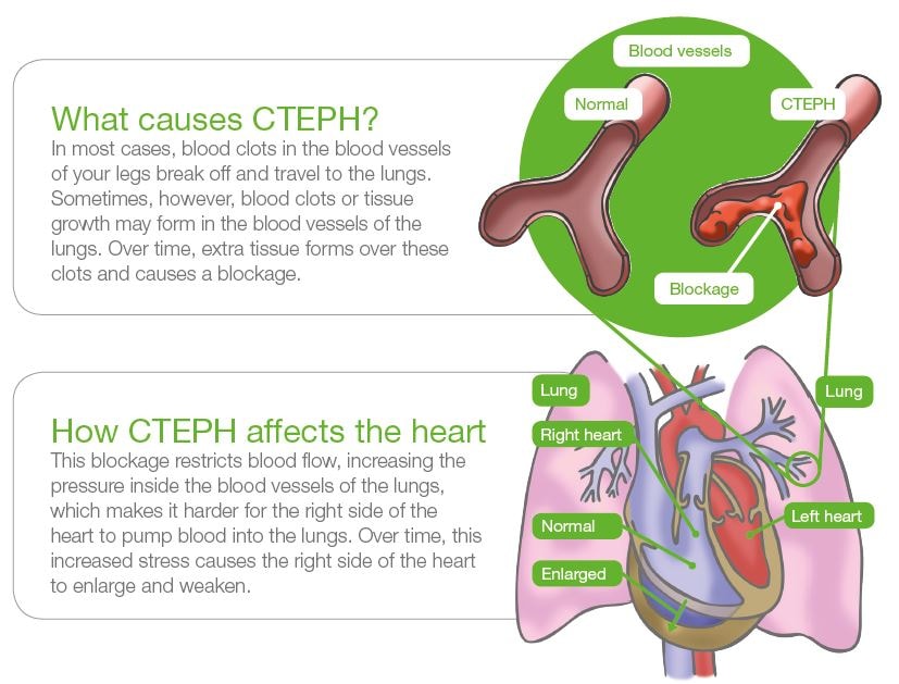 CTEPH Symptoms Risk Factors Patient information